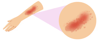Rash from contact dermatitis